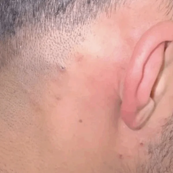 Turkse kapper verwijdert drie jaar oud ingegroeid haartje &mdash; video gaat wereldwijd viraal