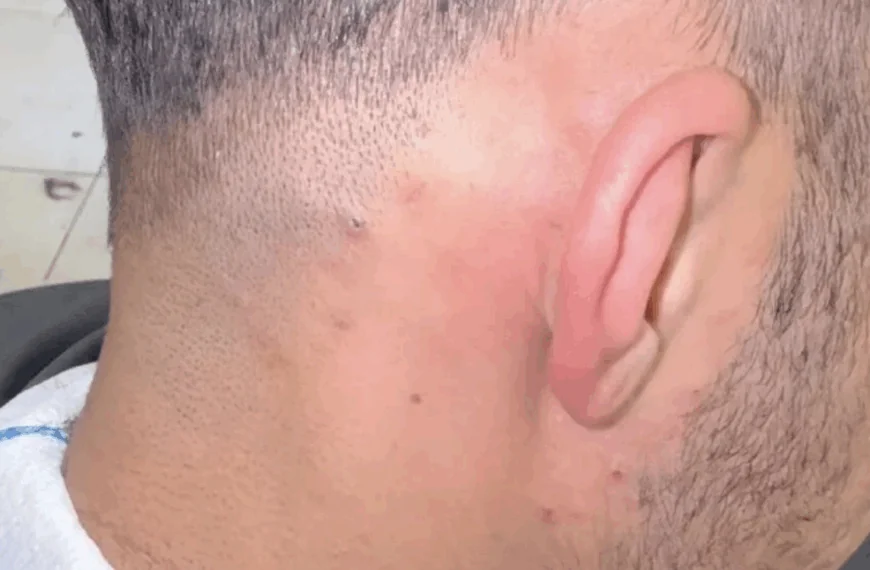 Turkse kapper verwijdert drie jaar oud ingegroeid haartje — video gaat wereldwijd viraal