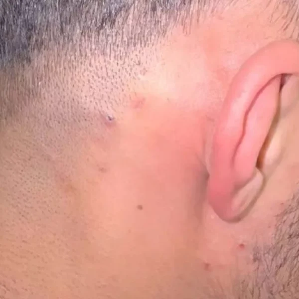 Kapper ontdekt jarenoude ingegroeide haar en maakt onverwachte &lsquo;operatie&rsquo; mee die het internet verovert