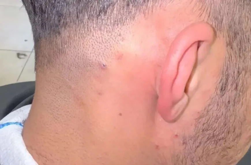 Kapper ontdekt jarenoude ingegroeide haar en maakt onverwachte &lsquo;operatie&rsquo; mee die het internet verovert