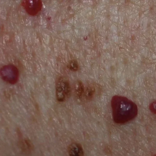 Rode stippen op de huid: wat betekenen ze en wanneer moet je actie ondernemen?