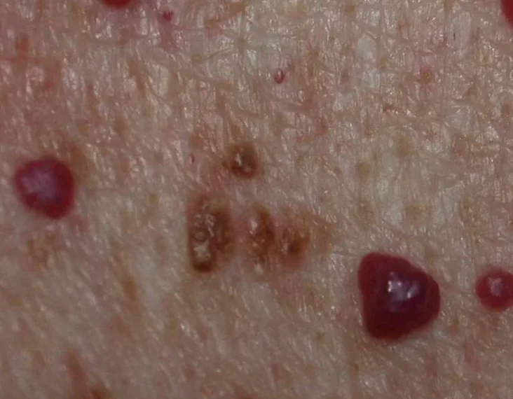 Rode stippen op de huid: wat betekenen ze en wanneer moet je actie ondernemen?